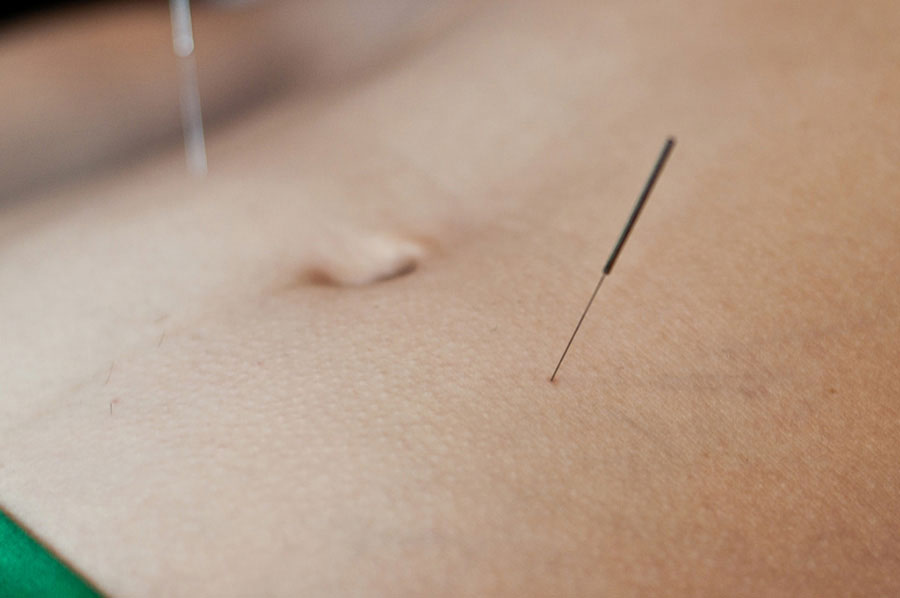 Acupuncture-for-Chronic-Upset-Stomach